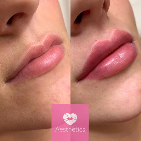 Facial Aesthetic Specialists on Instagram: “Fill the world with love 💉💖 Heart Sculpt lips : This technique aims to give you perfect heart shaped lips. Heart shaped lips are…” Heart Shaped Lips Natural, Full Heart Shaped Lips, Facial Aesthetic, Heart Shaped Lips, Perfect Heart, Facial Aesthetics, You Are Perfect, Heart Shapes, Facial