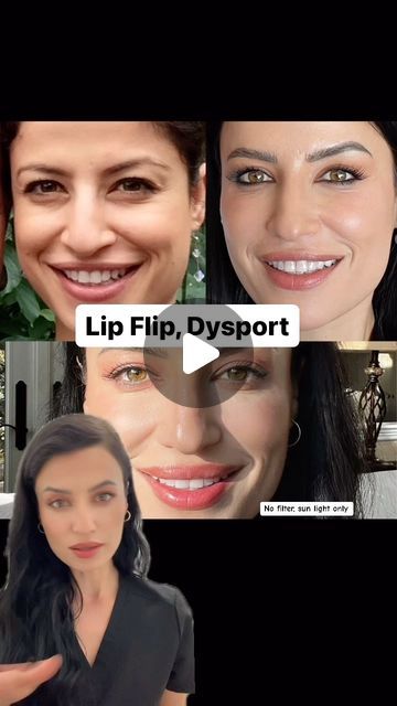 Lone Tree Aesthetics Medical Spa on Instagram: "Injecting in this area relaxes the muscle, which allows the upper lip to roll outward, creating a fuller, more defined look. I used 24 units of Dysport which equals 8 units of Botox . #lipflip #lipflipresults #dysport #dysportinjections #beforeandafter #fullerlips #nurseinjector #botulinumtoxin #reelsinstagram #ig #instagood" Lip Flip Fibroblast, Lip Flip Botox Before And After, Botox Lips, Botulinum Toxin, Lone Tree, Medical Spa, Upper Lip, Spa, Medical