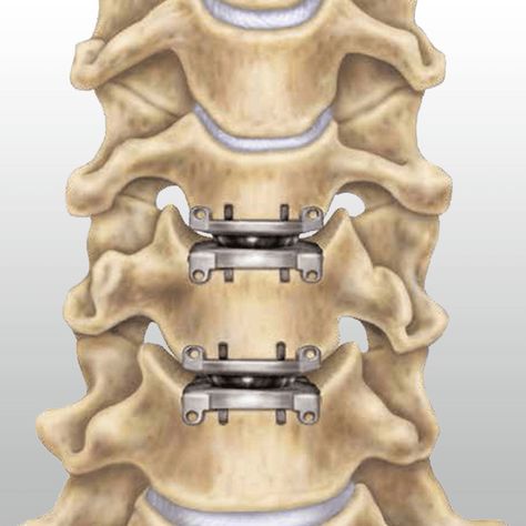 Medtronic, DePuy Synthes Lead Cervical and Lumbar Artificial Disc Market - http://www.orthospinenews.com/medtronic-depuy-synthes-lead-cervical-and-lumbar-artificial-disc-market/ Cervical Disc, Physical Therapy Student, Lumbar Disc, Neck Surgery, Neck Exercises, Spine Surgery, Industrial Design Sketch, Surgery Recovery, San Michele