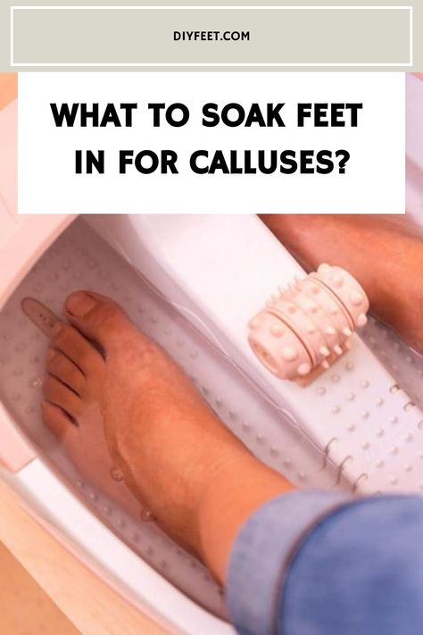 What to Soak Feet in For Calluses? Dry Calloused Feet Remedy, Remove Calluses On Feet Remedies, Diy Callus Remover, How To Remove Calluses From Foot, Calloused Feet Remedy, Foot Scrub Diy Exfoliating, How To Get Rid Of Calluses On Feet Fast, Calluses On Feet Remedies, Foot Soak For Calluses