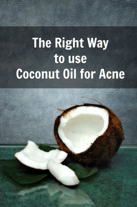 Have you tried all sorts of medications for your acne, and nothing really worked? May be it's time to go all natural and use coconut oil for acne. Coconut oil is a "super oil" with an impressive prof Blackhead Remedies, Diy Coconut Oil, Coconut Oil For Acne, Coconut Oil Skin Care, Coconut Oil Recipes, Coconut Oil Hair Mask, Coconut Oil For Face, Clear Healthy Skin, Get Rid Of Acne