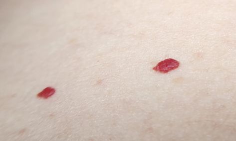 If You Spot These Red Dots On Your Skin, You Had Better Know What They Mean How To Get Rid Of Red Spots On Face, Red Dots On Skin, Red Moles On Skin, Red Bumps On Face, Trypophobia Skin, Red Spots On Skin, Red Spots On Face, Red Skin Spots, Red Moles