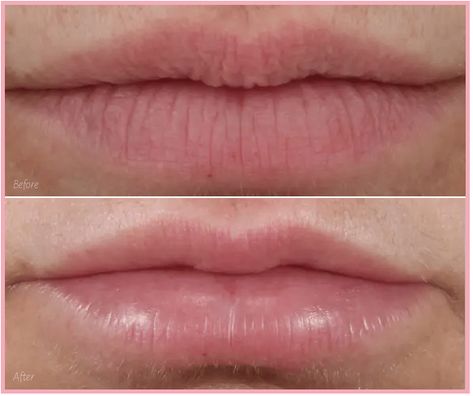 Vertical lip lines are notorious for giving away a person’s age. What’s more, everyday solutions to cover them up just don’t work. There are better nonsurgical solutions (this lip before and after is just one!) #botox #cosmeticinjectables #dermalfillers #fillers #injectables #PlateletRichPlasma #PRP Smoker Lines Before And After, Lip Filler For Smoker Lines, Best Lip Plumping Gloss, Upper Lip Wrinkles, Smokers Lines, Mouth Wrinkles, Reverse Aging Skin, Botox Filler, Botox Lips