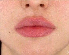 Lip Goals Natural, Natural Overlined Lips, Lip Filler No Cupids Bow, 5 Ml Lip Filler, Full Pouty Lips, Natural Plump Lips Aesthetic, Heavy Bottom Lip, 0 5 Ml Lip Filler, Natural Lips Aesthetic