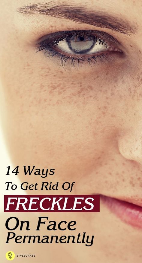 Freckles On Face, Getting Rid Of Freckles, Flat Warts, Warts On Hands, Warts On Face, Remove Warts, Get Rid Of Warts, Cystic Acne, Layers Of Skin