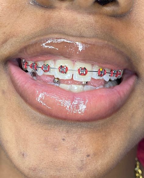 @bracesbytaiwo #fashion #style #beauty #photoftheday #stylish #love #cute #beautiful #instagood #fyp #braces #foryoupage Orange Braces, Pretty Braces, Cute Braces Colors, Getting Braces, Art Facts, Cute Braces, Braces Colors, Dental Braces, Love Cute