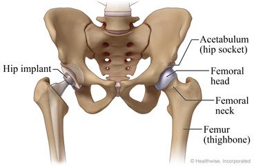 Hip Replacement Surgery (Anterior): What to Expect at Home Vein Thrombosis, Hip Surgery, Have More Energy, Degenerative Disease, Compression Stockings, Emergency Department, Family Doctors, Case Management, Hip Pain