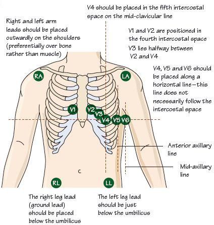 12 leads ekg placement Telemetry Lead Placement, Ekg Leads Placement, 12 Lead Ekg Placement Cheat Sheets, 12 Lead Ekg Placement Nursing Students, 12 Lead Ekg Cheat Sheet, Ekg Placement 12 Lead, Ecg Lead Placement, Ekg Lead Placement, 12 Lead Ekg Placement