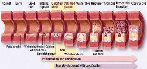 How to Reverse 20 Years of Arterial Plaque | Prevmedhealth Vitamin K2 Benefits, Clear Arteries, Whole Body Cleanse, Body Cleanse Diet, Body Detox Cleanse, Low Histamine Diet, Preventive Medicine, Coronary Arteries, Vitamin K2