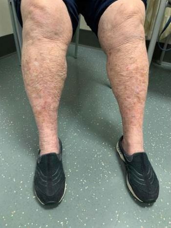 Medication for venous insufficiency: Are they Useful? Fibromuscular Dysplasia, Peripheral Artery, Vein Thrombosis, Venous Insufficiency, Swollen Legs, Leg Pain, Healthcare Professionals, The Public, Disease