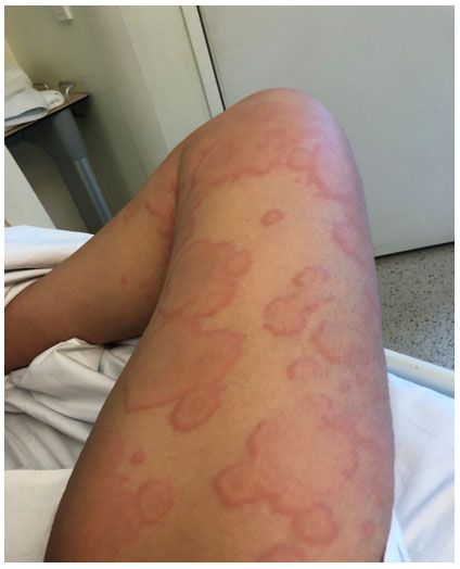 serum sickness 1 Skin Conditions Pictures, Steven Johnson Syndrome, Hypersensitivity Reactions, High Fever, Reference Pictures, Signs And Symptoms, Speaking English, New Skin, Dermatology