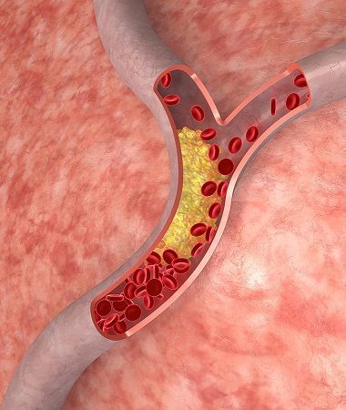 Cholesterol-Lowering Drugs Fail Again Regime Anti Cholesterol, Tlc Diet, What Causes High Cholesterol, Low Cholesterol Diet, High Cholesterol Levels, Cholesterol Medications, Cholesterol Remedies, Cholesterol Lowering Foods, Lower Your Cholesterol