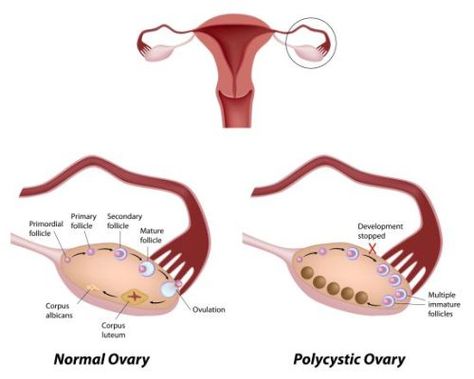 Home remedies for polycystic ovary syndrome include use of saw palmetto, fenugreek, salmon, flaxseed, spearmint tea, cinnamon, licorice, broccoli, apple cider vinegar and spinach Health Changes, Basic Anatomy, Endocrine Disorders, Fertility Problems, Metabolic Disorders, Polycystic Ovarian Syndrome, Polycystic Ovaries, Women Health, Medical Knowledge