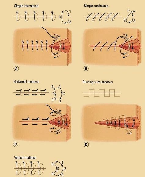 Useful Diagram ➡ Different Types Of Surgical Suture #doctor #medicine #medical #medschool #surgeon Mortician Career Outfits, Sutures Types, Suture Types, Surg Tech, Surgical Suture, Studera Motivation, Surgical Technologist, Vet Medicine, Surgical Nursing