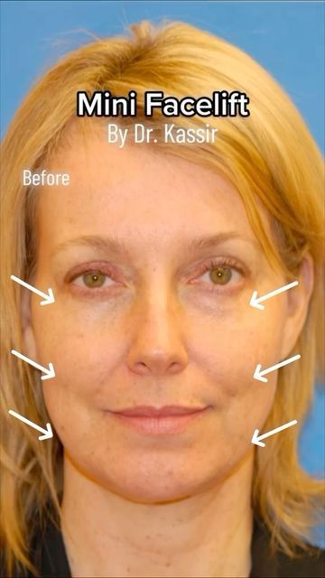 Plastic Surgeon Dr. Kassir on Instagram: "Only 5 days after Mini Facelift 😍 (under local anesthesia)

Just like a full facelift, the Band Aid Facelift separates and tightens the underlying muscles and removes excess skin on the cheeks and jawline. A Band Aid Face Lift is our version of a mini face Lift so less recovery and you can get back to work faster.

After the procedure we combined it with CO2 Laser Skin Resurfacing. It involves using lasers to help improve skin texture and appearance.
You might consider Laser Skin Resurfacing if you have aged, acne-related skin care concerns that aren’t treatable with over-the-counter products.

Her jowls, jawline and neck bothered her and she wanted a fresher look.

While nonsurgical options are always available, when you have:

1.  Gravity change Lower Face Lift Before And After, Mini Face Lift Before And After, Lower Face Lift, Mini Face Lift, Local Anesthesia, Laser Skin Resurfacing, Excess Skin, Skin Resurfacing, Laser Skin