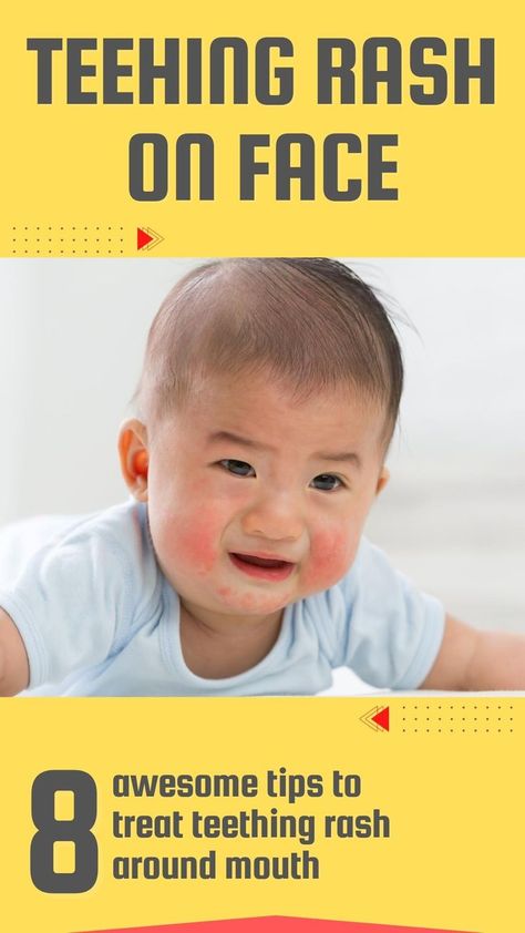 Article explains causes, how to identify and treat teething rash on face along with important tips and FAQs on teething rash around mouth | teething | teething rash | baby teething remedies | baby teething hacks | teething hacks | home remedies for teething rash #parentingnmore #teething #parentingtips #teethinghacks Teething Rash On Face, Rash Around Mouth, Baby Teething Hacks, Teething Relief For Babies, Face Rash Remedies, Teething Molars Relief, Baby Rash On Face, Teething Rash, Remedies For Teething Babies