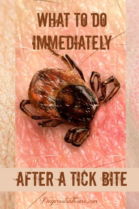 What To Do Immediately For Lyme Disease After A Tick Bite. #healthy #ideas #lifestyle #health #medicine #insects #lymedisease #life #mosquitos #lyme #wellness #outdoor #natural #disease #healthyliving #camping #nature #hiking #gardening #disease #wisdom #plants #healing #insects #insectrepellent #sick #science #blood #study #amazing  via @deeprootsathome Deer Tick Bite, Homemade Medicine, Deer Ticks, Tick Removal, Tick Bite, Tick Repellent, Health Medicine, Camping Nature, Medical Laboratory Science