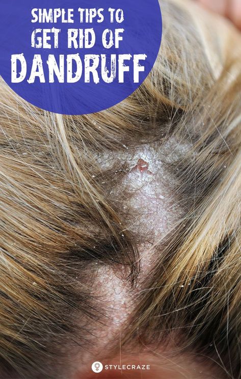 Get Rid Of Dandruff Permanently, Child Hairstyles, Treat Dandruff, Home Remedies For Dandruff, Rid Of Dandruff, Dandruff Hair, Dandruff Remedy, Types Of Manicures, Getting Rid Of Dandruff