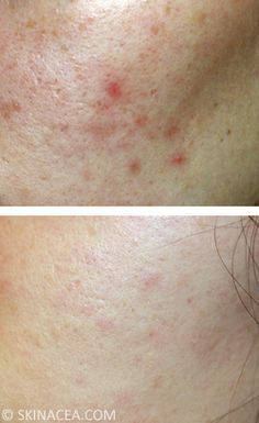 How to Fade Post-Acne Red Marks, Dark Spots, Pigmentation, Etc. | Skinacea.com Laser Acne Scar Removal, Sun Spots On Skin, Sunspots On Face, Brown Spots On Hands, Fade Acne Marks, Brown Age Spots, Acne Laser, How To Fade, Brown Spots On Skin