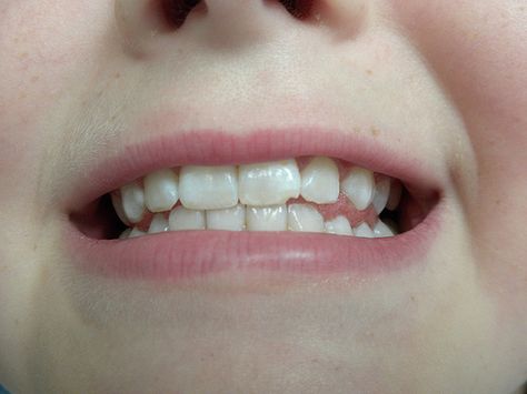 Tooth repair ( bonding) Note the small chip on the front tooth on the right side of the photograph. Chipped Tooth Aesthetic, Pointed Teeth Aesthetic, Wisdom Teeth Aesthetic, Missing Teeth Aesthetic, Gapped Tooth Smile, Teeth Bonding, Dentist Branding, Teeth Aesthetic, Chipped Tooth