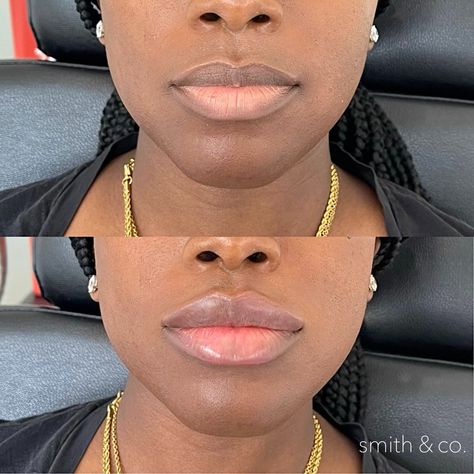 Lip Filler Technique, 1ml Lip Filler, Lip Lift, Lips Inspiration, Botox Before And After, Danielle Smith, Botox Lips, Body Makeover, Facial Fillers