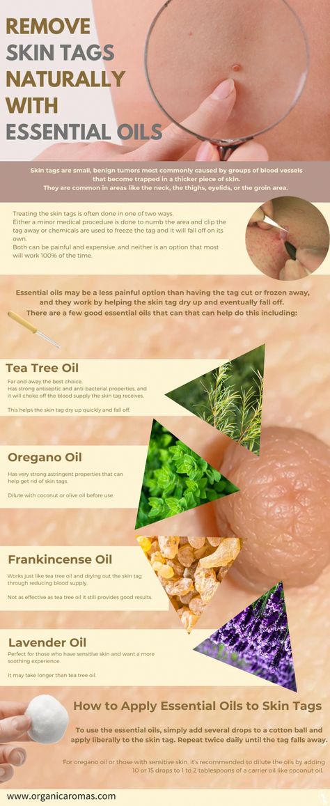 Skin Tags Essential Oils, Skin Tags Removal, Remove Skin Tags Naturally, Natural Remedies For Cough, Remove Skin Tags, Remedies For Cough, Home Remedy For Cough, Cold Sores Remedies, Essential Oil Blends Recipes