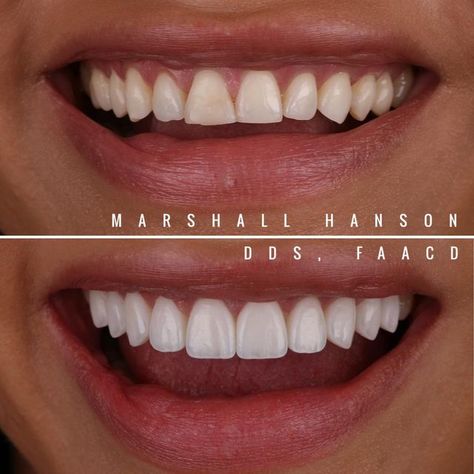 Veneers Teeth Styles, Natural Fangs Teeth, Veneers Before And After, Teeth Shaping, Teeth Inspiration, Perfect Teeth Smile, Natural Veneers, Short Teeth, Loose Teeth