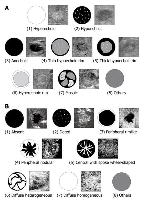 llustration of morphologic patterns of hepatic tumors in the B-mode ultrasonography; B: Illustration of enhancement patterns of hepatic tumors in the arterial phase Diagnostic Medical Sonography Student, Ultrasound School, Ultrasound Physics, Obstetric Ultrasound, Radiologic Technology, Sonography Student, Vascular Ultrasound, Ultrasound Sonography, Radiology Student