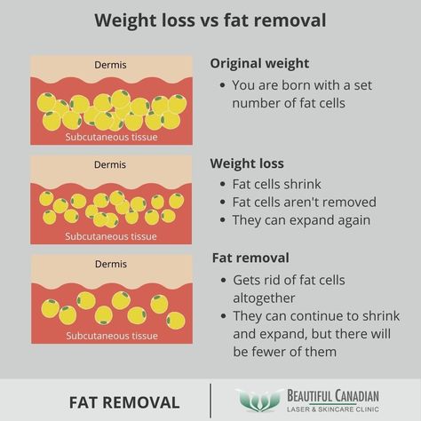 Laser Fat Removal, Visceral Fat Loss, Health Chart, Subcutaneous Tissue, Fat Freezing, Fat Loss Program, Cool Sculpting, Visceral Fat, Natural Healing Remedies