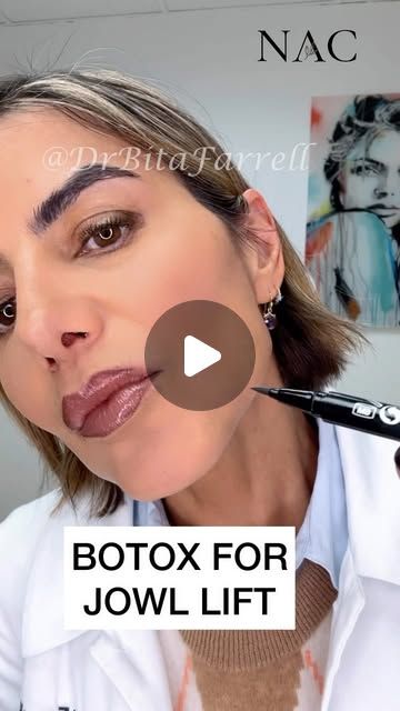 Dr. Bita Zadeh Farrell on Instagram: "To simplify, muscles of the face either pull up or down. The DAO attaches to the corner of the mouth and pulls down, worsening marionette lines and jowls.  The platysma muscle is a sheet muscle that attaches to the jawline and contracts the jawline down, shortening the neck and worsening jowls.  When these two muscles are injected and relaxed using a Neuromodulator like Botox, the cheek muscles (Zygomaticus major and minor) dominate and have an easier time pulling up.  This lifts the jawline, lifts the neck (Nefertiti neck lift) and improves mild jowls.   *PLEASE NOTE: This treatment is for mild jowls.  Moderate to heavy jowls may require additional treatments such as fillers, Biostimulators or even surgery. *  Average standard units required are   4-8 Nefertiti Botox Lift, Botox For Jowls, Botox Jawline Before And After, Botox Mapping, Botox Eyes, Platysma Muscle, Aesthetics Business, Pimple Cream, Muscles Of The Face