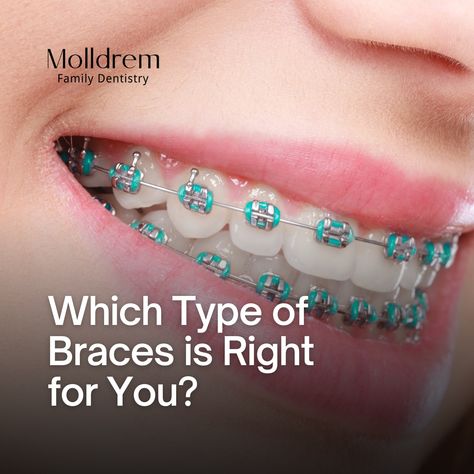 Brace yourself for some smile transformation knowledge! Swipe right to explore your options to a straighter smile! 😁✨ 1️⃣ Traditional Metal Braces: Classic but Cool 2️⃣ Ceramic Braces: Subtle and Sophisticated 3️⃣ Lingual Braces: The Hidden Heroes 4️⃣ Invisalign: Embrace the Invisible 🌐 Each option has its own unique benefits, and we've got all the details waiting for you in our full blog! Braces Transformation, Smile Transformation, Lingual Braces, Ceramic Braces, Types Of Braces, Sedation Dentistry, Teeth Straightening, Metal Braces, Dental Veneers