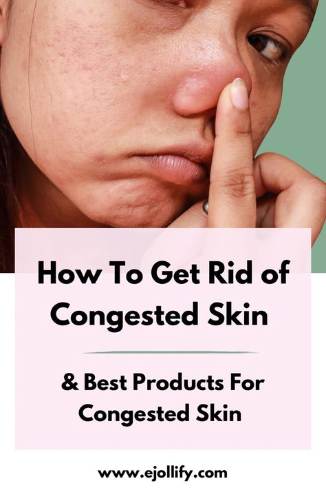 How To Get Rid of Congested Skin & Products For Congested Skin Skin Care Routine For Whiteheads, Best Products For Clogged Pores, How To Treat Blackheads On Nose, How To Get Rid Of Congested Skin, How To Treat Whiteheads, How To Treat Pores On Face, Skin Care For Clogged Pores, Skin Care Routine For Oily Skin And Large Pores, Clogged Pores On Chin