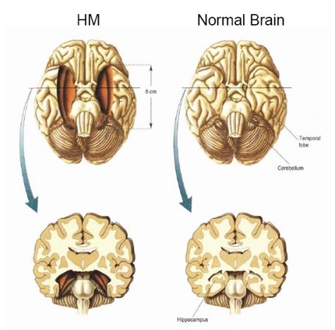 Story from National Public Radio (NPR) about H.M., the man who had the bilateral removal of his hippocampus (What is the plural of hippocampus?) and ended up with the nearly complete inability to form new memories. Find out why he had his hippocampus removed and learn about this amazing case study of anterograde amnesia. Anterograde Amnesia, Psychology Blog, Ap Psychology, New Memories, Brain Science, Science Degree, Behavioral Science, Body Systems, Memory Games