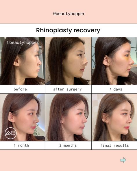 #plasticsurgeryinkorea #plasticsurgerykorea #plasticsurgeryconcierge #medicaltourism #medicaltourismkorea #koreanplasticsurgery #plasticsurgerybeforeandafter #beautyhopper #doubleeyelidsurgery #rhinoplasty #vlinesurgery #rhinoplastykorea #seoulplasticsurgery #koreavlog #koreatrip #beautytrip #gangnamplasticsurgery #beautyconsultant #koreaplasticsurgery #kbeauty #revisionrhinoplasty #asianrhinoplasty V Line Surgery, Trip To Korea, Plastic Surgery Korea, Korean Plastic Surgery, Rhinoplasty Before And After, Double Eyelid, Medical Tourism, Beauty Consultant, Korea Travel