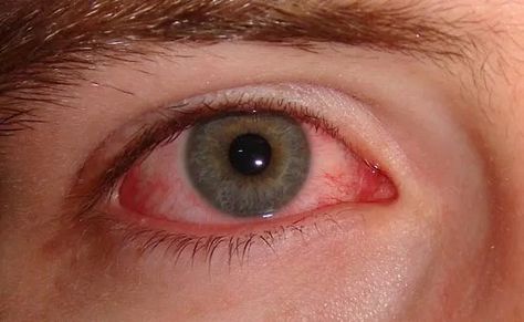 Conjunctivitis—often called “pink eye”—is inflammation of the conjunctiva from infection or allergies. Treating Pink Eye, Natural Pink Eye Remedy, Eye Stye Remedies, Pinkeye Remedies, Eye Infections, Pink Eye, Eyes Problems, Olivia Munn, Farrah Fawcett