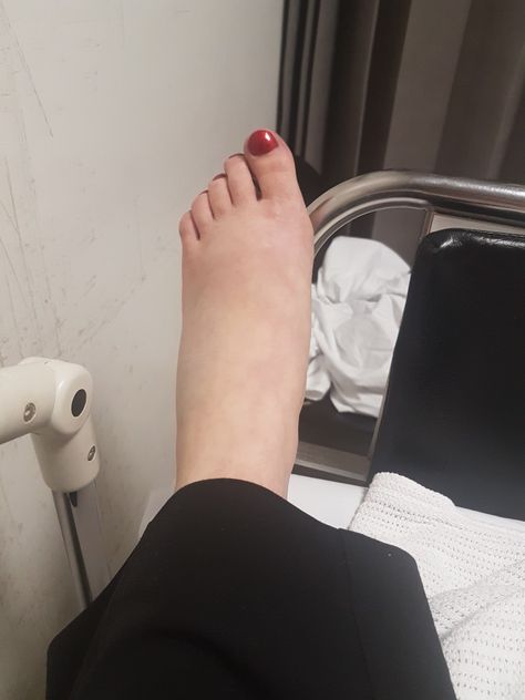 Lisfranc Injury pre surgery day of accident Lisfranc Injury, Accident Injury, Leg Injury, Delivery Pictures, New Photo Download