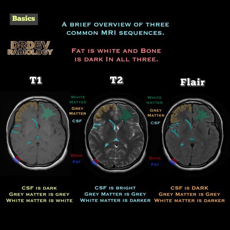 Mri Brain, Radiology Imaging, Anatomy Bones, How The Universe Works, Medicine Studies, Basic Anatomy And Physiology, Grey Matter, White Matter, Mri Scan