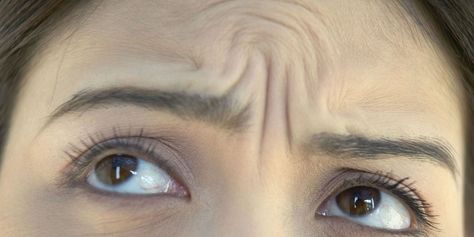 Erase Your "Angry" Wrinkles in a Snap Wrinkle Between Eyebrows, Hide Wrinkles, Anti Aging Smoothie, Anti Aging Skin Care Diy, Chest Acne, Get Rid Of Wrinkles, Anti Aging Face Serum, Anti Aging Secrets, Forehead Wrinkles