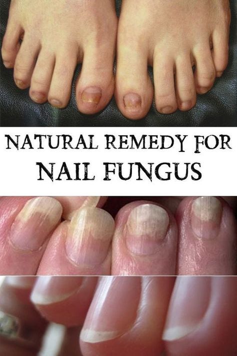 Top Home Remedies for Nail Fungus Nails Remedies, Nail Remedies, Antifungal Cream, Toenail Fungus Remedies, Makeup Smokey, Nail Fungus Remedy, Male Fitness, Fungal Nail, Health Signs