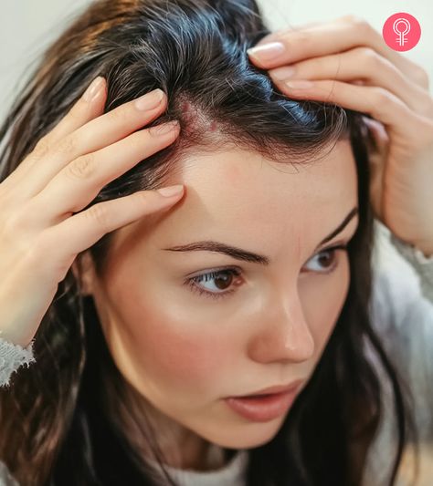 Often caused by an ill-fitting hat or winter weather, a scab on the scalp can be painful and embarrassing. So, how do you treat scabs on the scalp? Click here. Dry Patches On Scalp, Scalp Picking, Hairstyle For Baby Girl, Scalp Scabs, Quotes About Goals, Scaly Scalp, Pimples On Scalp, Sores On Scalp, Acv Hair