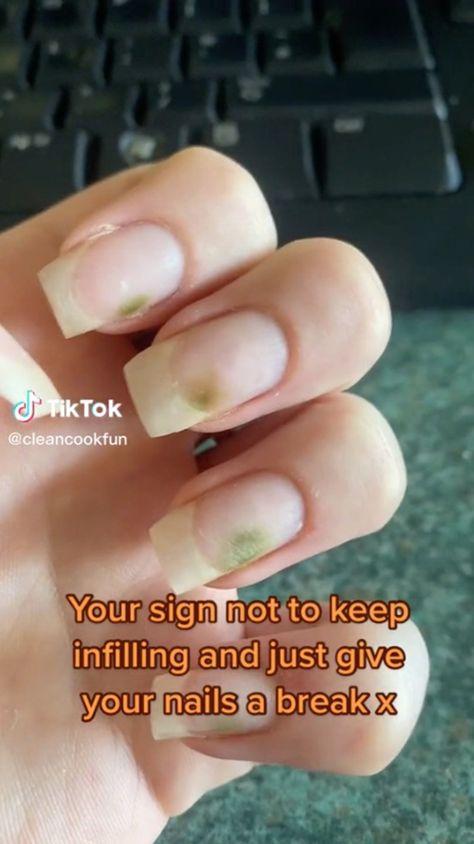 Green Nail Syndrome, Nail Growth Faster, Lemon Health, Nail Remedies, Fingernail Fungus, So Disappointed, Nail Fungus Remedy, Nail Infection, Fungal Nail