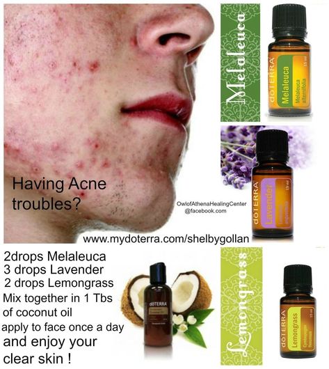 Doterra Acne, Essential Oil Roller Bottle Recipes, Doterra Oils Recipes, Essential Oil Perfumes Recipes, Esential Oils, Essential Oils For Face, Doterra Essential Oils Recipes, Essential Oil Remedy, Diy Acne