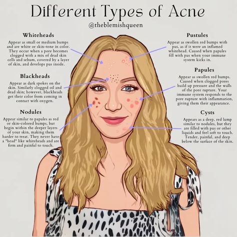 Acne types How To Close Pores On Face, Close Pores On Face, How To Close Pores, Acne Types, Closed Comedones, Acne Routine, Different Types Of Acne, Mild Acne, Acne Vulgaris