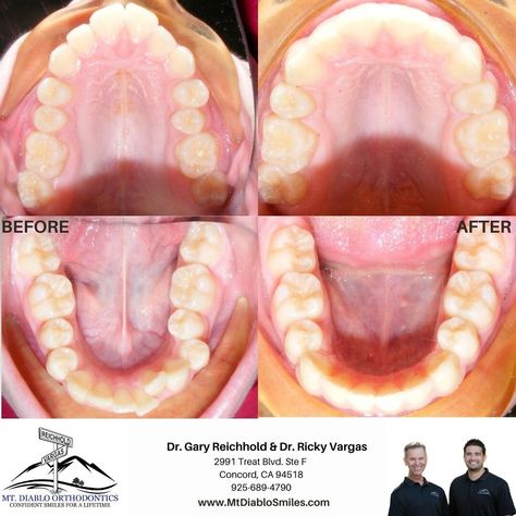 🦷TRANSFORMATION TUESDAY🦷 Occasionally, we will refer to have teeth extracted, due to the severity of the crowding and it's negative effects to surrounding teeth. In this case, the patient had crowding as well as narrow arches and a deep bite, so it was necessary to extract all 4 bicuspids. This helped to alleviate the crowding and allowed us to reduce the protrusion. We placed upper and lower braces once the extractions were completed to reduce the overjet and overbite, as well as align and level the arches. Call us for your complimentary consultation! 📞925-689-4790 #Orthodontics #ortholife #smileconfidently #MtDiabloSmiles #mtdiabloorthodontics #Eastbay #DiabloValley #Concordca #walnutcreekca #straightteeth #gr8smiles #dental #braces Crowding Teeth, Dental Braces, Straight Teeth, Teeth Braces, The Patient, Transformation Tuesday, Braces, Vision Board, Arch