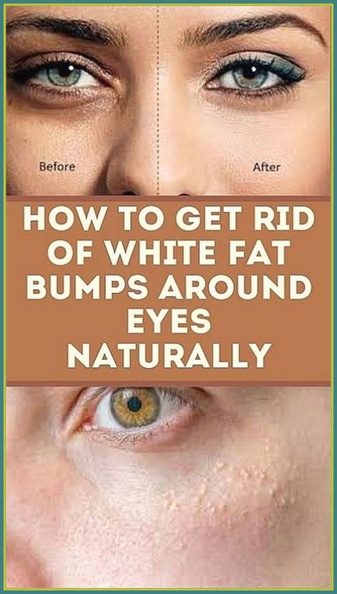 How to Get Rid of White Fat Bumps Around Eyes Naturally Bumps Under Eyes, Blind Pimple, Pimples Under The Skin, Under Eyes, Skin Care Treatments, Skin Problems, Bump, Beauty Skin, Natural Remedies