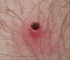 Tick removal | Patterson Greenhouses The Tick, First Aid Tips, Tick Removal, Cotton Balls, Homemade Remedies, Aid Kit, Cotton Ball, First Aid Kit, Home Health