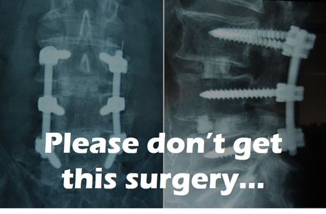 New Research: Low Back Fusion Surgeries Are Ineffective - Regenexx Blog Spinal Fusion Surgery, Spine Problems, Spinal Fusion, Spinal Surgery, Neck Surgery, Spine Health, Spine Surgery, Sciatic Nerve Pain, Learn Yoga