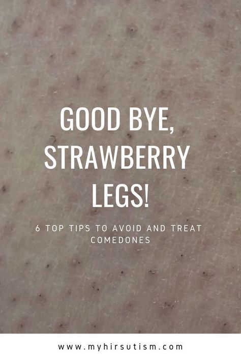 Comedones or strawberry legs are annoying. Here's how to get rid of them for good! Bumps On Legs Get Rid Of, How To Get Rid Of Shaving Bumps, Strawberry Bumps On Skin, Remove Strawberry Legs How To Get Rid, How To Remove Strawberry Legs At Home, Strawberry Skin How To Get Rid, Strawberry Legs Remedy How To Get Rid, Strawberry Legs Remedy, Bumps On Legs