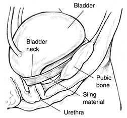 The urethral sling is placed right on the bladder neck and above the urethra Bladder Sling Surgery, Bladder Control, Pelvic Floor, Surgery, Medical, Mesh, Google Search