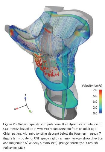 CHIARI FLOW STUDY: Subject-specific computational fluid dynamics simulation of CSF motion based on in vivo MRI measurements from an adult-age Chiari patient with mild tonsillar descent below the foramen magnum7 (figure left = posterior CSF space, right = anterior; arrows show direction and magnitude of velocity streamlines). (Image courtesy of Soroush Pahlavian, MS.) Arrow Show, Computational Fluid Dynamics, Chiari Malformation, Cerebrospinal Fluid, Fluid Dynamics, Engineering Projects, Research Center, Neurology, Dream Job